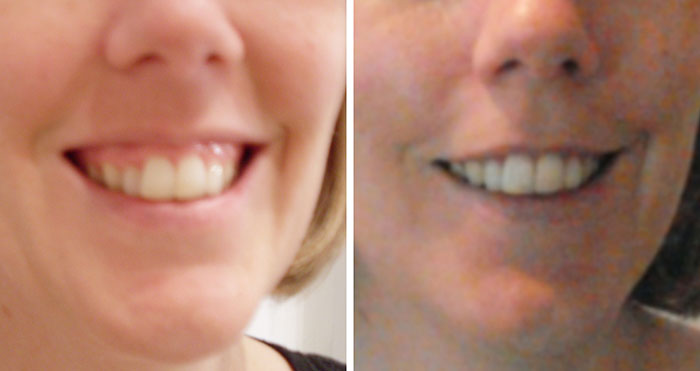 Gummy Smile | Hide Gums and Achieve an Even Smile with Botox